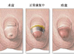 生殖整形案例2